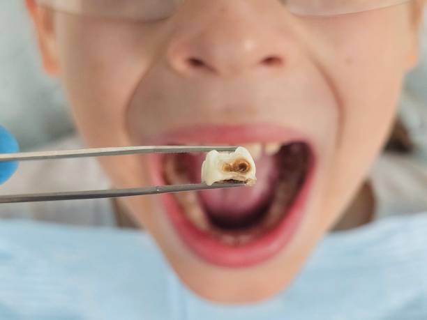 Best Emergency Tooth Extraction in Lagrange, IN